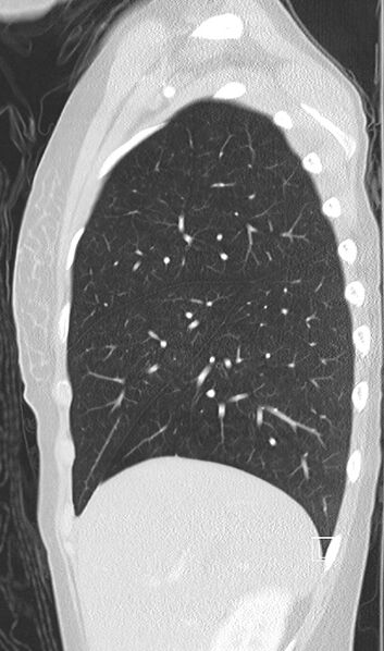 File:Bronchial atresia (Radiopaedia 73677-84470 Sagittal lung window 13).jpg