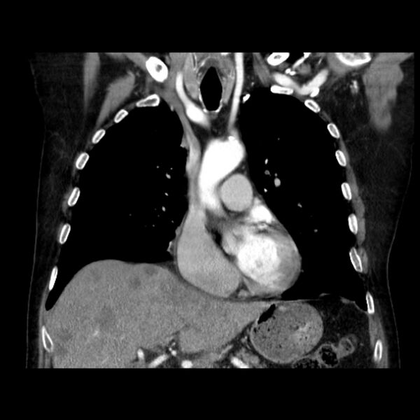 File:Bronchogenic adenocarcinoma and pulmonary embolism (Radiopaedia 9097-9806 C 20).jpg