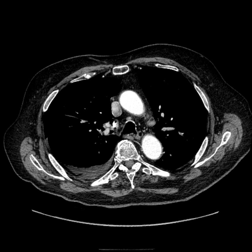 Bronchogenic adenocarcinoma and pulmonary embolism (Radiopaedia 9097-9806 D 25).jpg