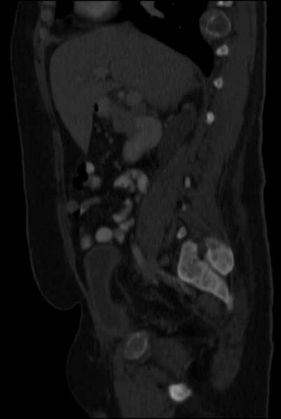 File:Brown tumors compressing the spinal cord (Radiopaedia 68442-77988 H 23).jpg