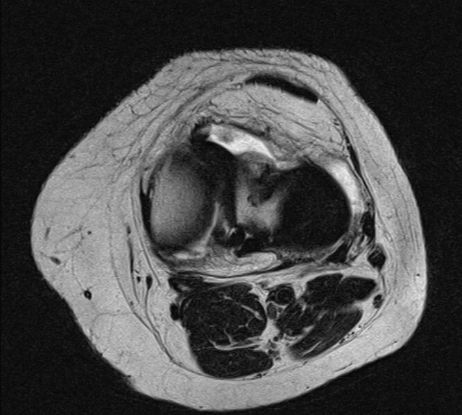 File:Bucket handle tear - medial meniscus (Radiopaedia 79028-91942 Axial T2 10).jpg