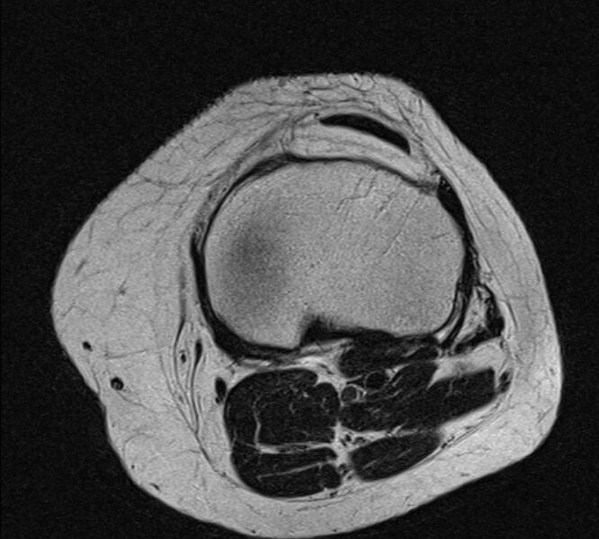 File:Bucket handle tear - medial meniscus (Radiopaedia 79028-91942 Axial T2 7).jpg
