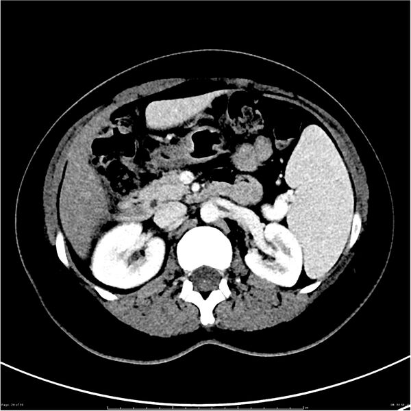 File:Budd-Chiari syndrome (Radiopaedia 27929-28177 Axial liver window 26).JPG