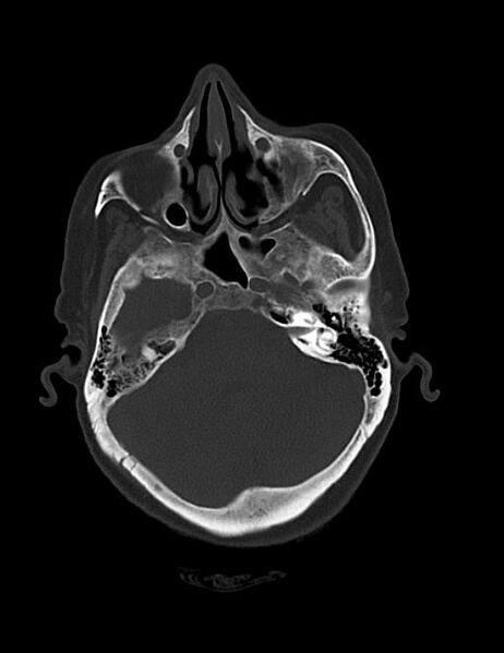 File:Burnt-out meningioma (Radiopaedia 51557-57337 Axial bone window 12).jpg