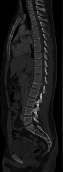 File:Burst fracture (Radiopaedia 83168-97542 Sagittal bone window 65).jpg