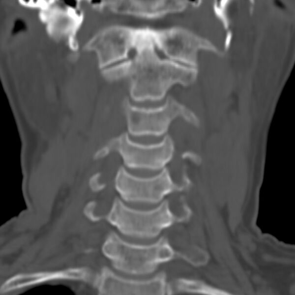 File:Calcified meningioma - cervical canal (Radiopaedia 70136-80171 Coronal bone window 2).jpg