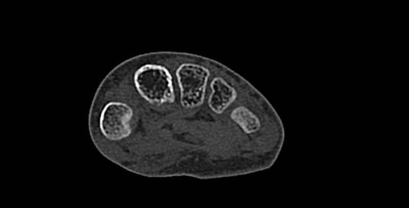 File:Calcifying aponeurotic fibroma (Radiopaedia 88423-105064 Axial bone window 127).jpg