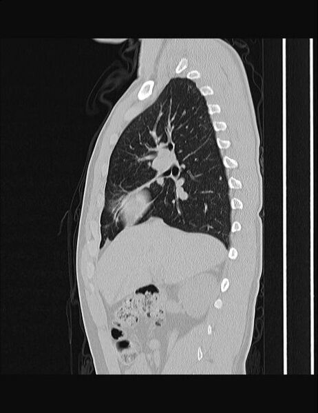 File:Calcifying pulmonary metastases (Radiopaedia 33359-34396 Sagittal lung window 45).jpg