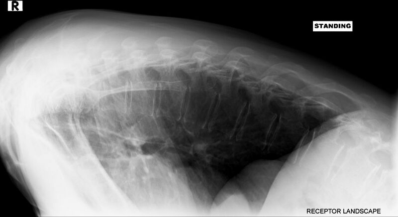 File:Camptocormia (bent spine syndrome) (Radiopaedia 46104-50456 Lateral 1).JPG