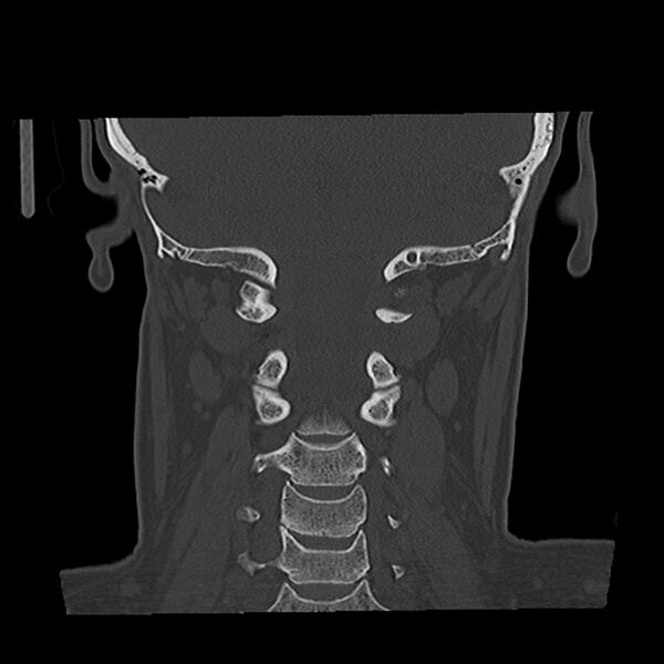File:Canal up mastoidectomy (Radiopaedia 78108-90638 Coronal bone window 44).jpg