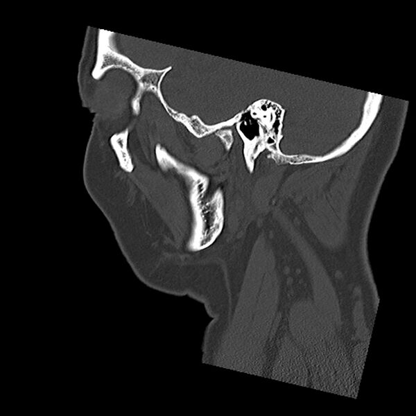 File:Canal up mastoidectomy (Radiopaedia 78108-90638 Sagittal bone window 14).jpg