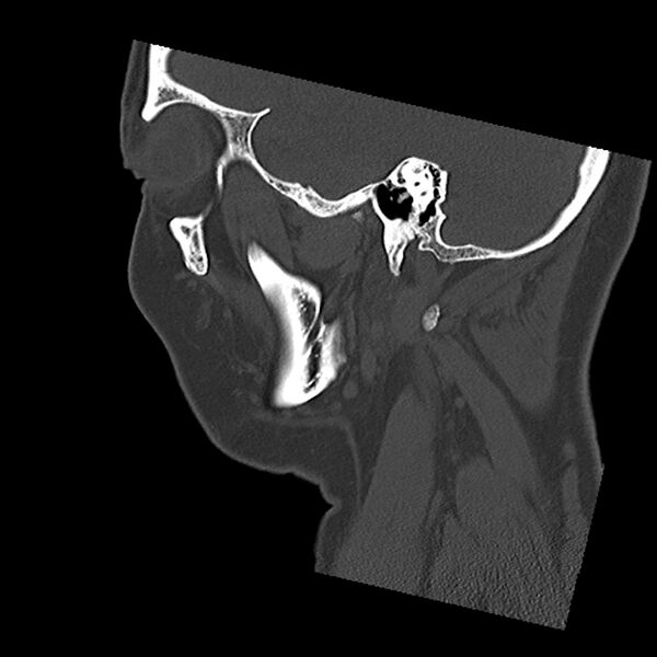 File:Canal up mastoidectomy (Radiopaedia 78108-90638 Sagittal bone window 15).jpg