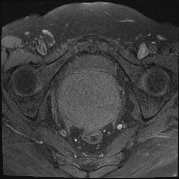 File:Cancer cervix - stage IIb (Radiopaedia 75411-86615 T1 fat sat 15).jpg