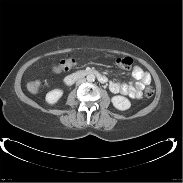 File:Carcinoid tumor of the ileum with metastasis to orbit (Radiopaedia 28165-28425 A 3).jpg
