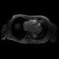 Cardiac fibroma (Radiopaedia 38974-41150 Axial SSFP 3).jpg
