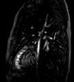 Cardiac hemangioma (Radiopaedia 16971-64065 Multiplanar 4).JPG