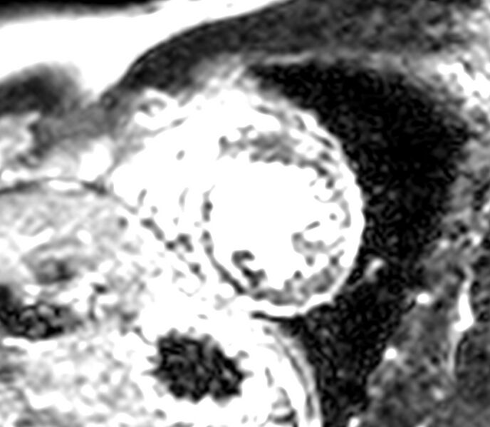 File:Cardiac sarcoidosis (Radiopaedia 39811-42243 LookLocker 7).jpg