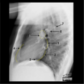Cardiomediastinal anatomy on chest radiography (annotated images) (Radiopaedia 46331-50747 Lateral 1).png
