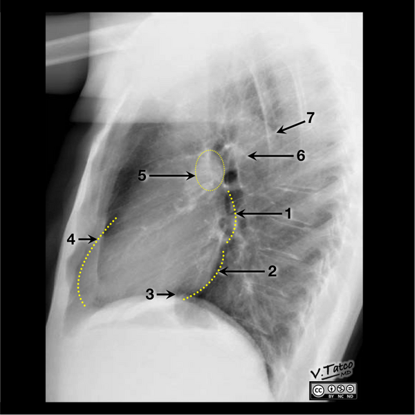 File:Cardiomediastinal anatomy on chest radiography (annotated images) (Radiopaedia 46331-50747 Lateral 1).png