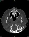 Cartilaginous nasal spetal perforation (Radiopaedia 88786).jpg