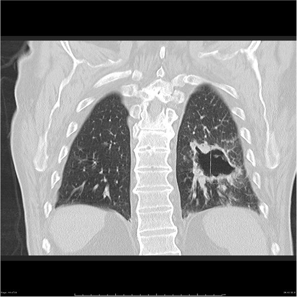 File:Cavitating left lower lobe lesion - squamous cell lung cancer (Radiopaedia 27749-28176 Coronal lung window 44).jpg