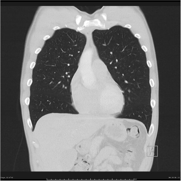File:Cavitating lung cancer (Radiopaedia 25796-25945 lung window 12).jpg
