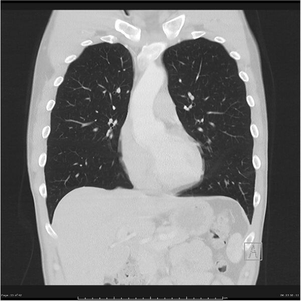 File:Cavitating lung cancer (Radiopaedia 25796-25945 lung window 15).jpg