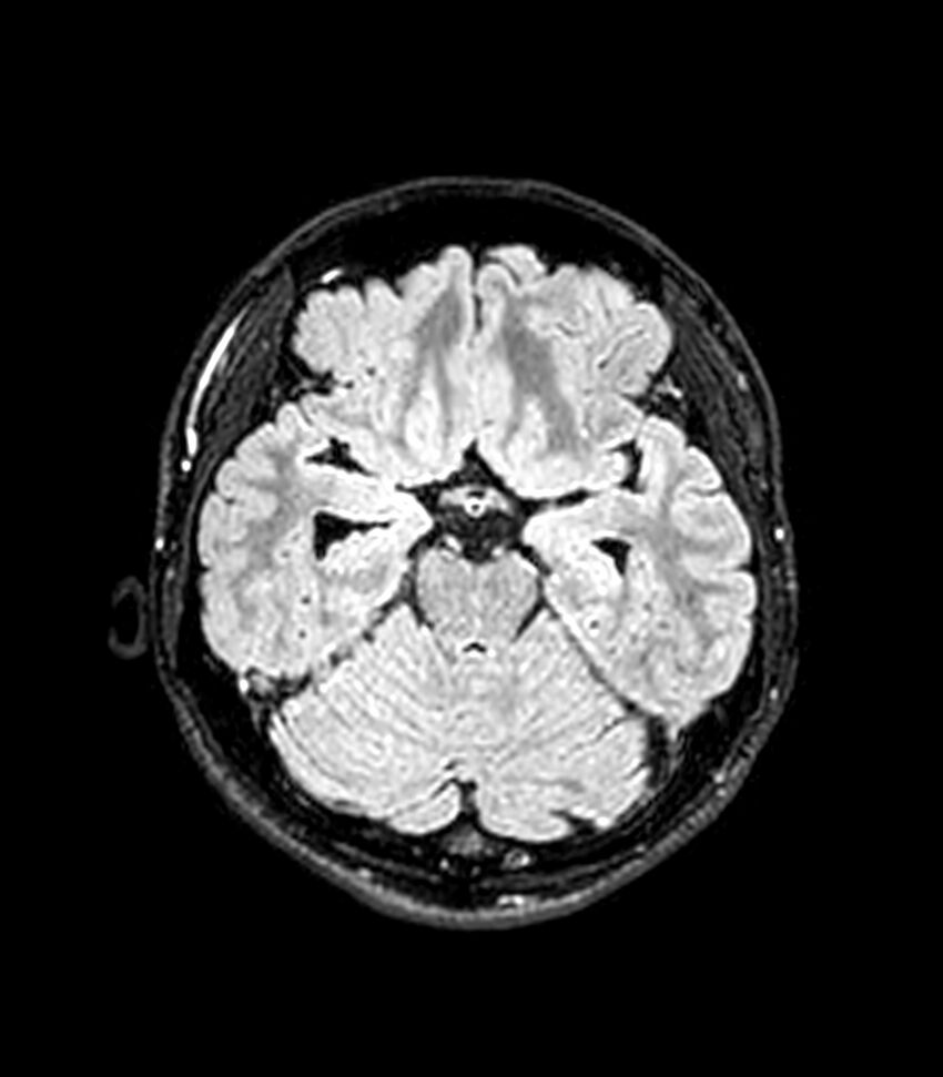 Central neurocytoma (Radiopaedia 79320-92380 Axial FLAIR 200).jpg