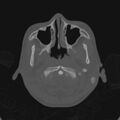 Cerebellar abscess secondary to mastoiditis (Radiopaedia 26284-26413 Axial bone window 10).jpg