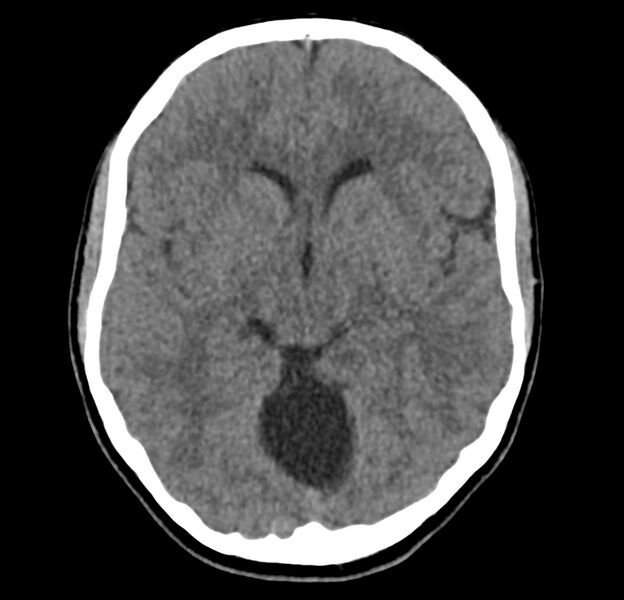 File:Cerebellar agenesis (Radiopaedia 30203-30817 Axial non-contrast 19).jpg