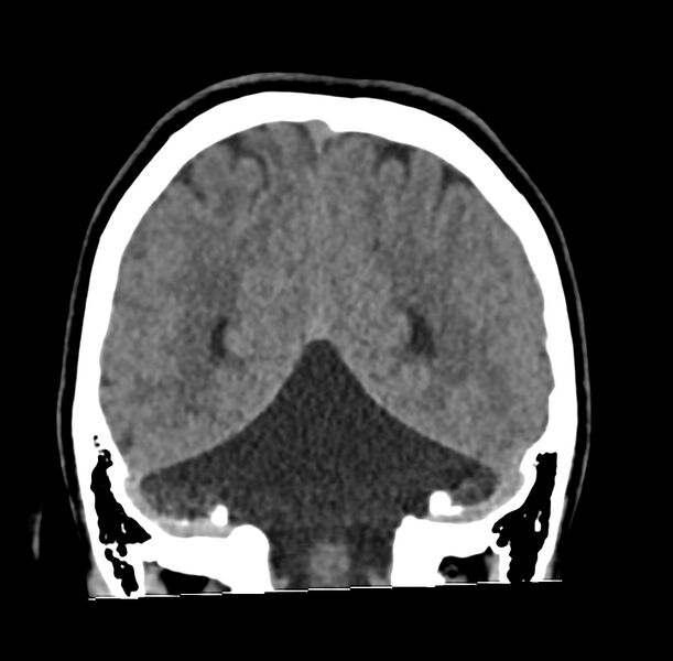 File:Cerebellar agenesis (Radiopaedia 30203-30817 Coronal non-contrast 34).jpg