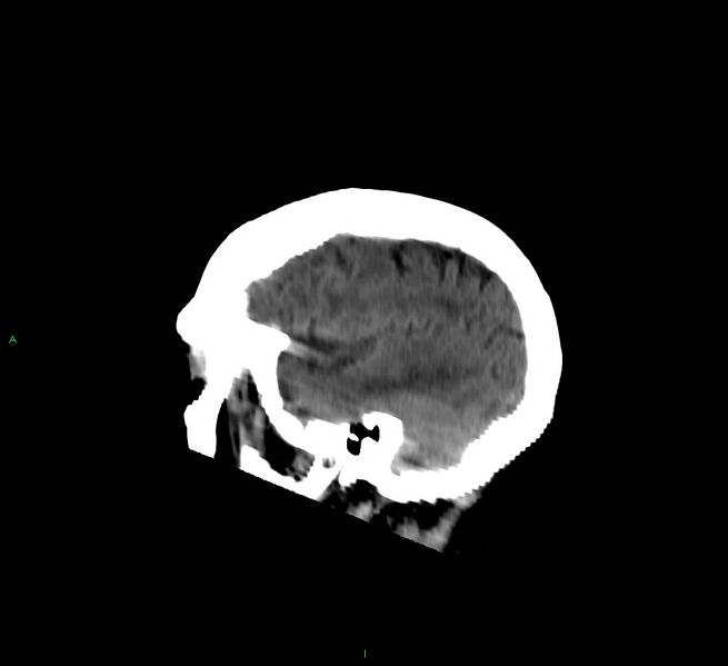 File:Cerebellar hemorrhage (Radiopaedia 58792-66026 C 40).jpg
