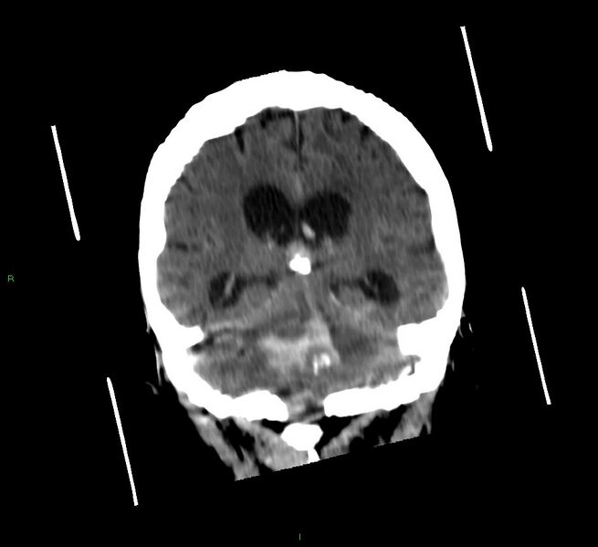 File:Cerebellar hemorrhage (Radiopaedia 58792-66026 Coronal non-contrast 28).jpg