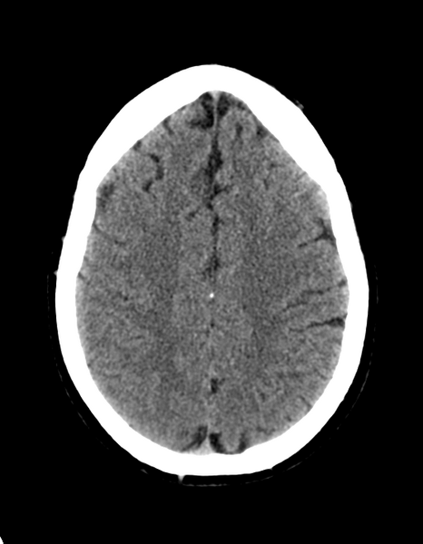 File:Cerebellar infarct due to vertebral artery dissection with posterior fossa decompression (Radiopaedia 82779-97030 Axial non-contrast 25).png