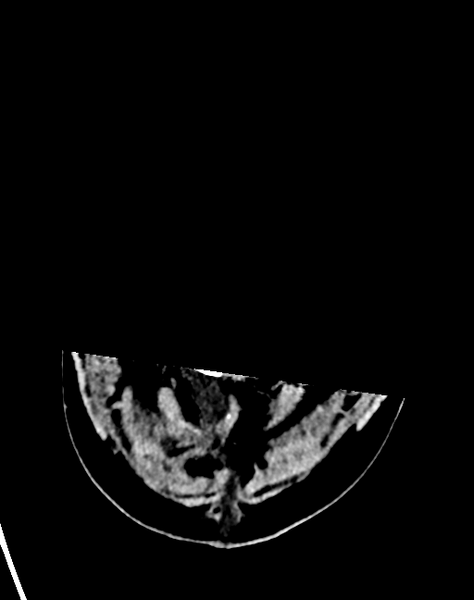 File:Cerebellar infarct due to vertebral artery dissection with posterior fossa decompression (Radiopaedia 82779-97033 Axial non-contrast 2).png