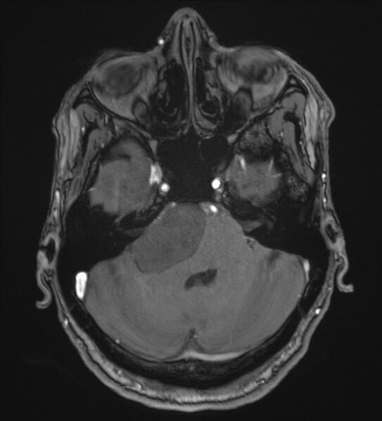 File:Cerebellopontine angle meningioma (Radiopaedia 72983-83680 Axial MRA 29).jpg
