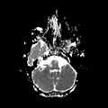 Cerebral abscess post cardiac surgery (Radiopaedia 27244-27420 Axial ADC 5).jpg
