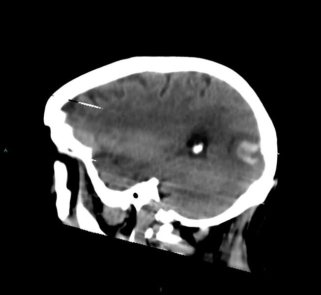 File:Cerebral amyloid angiopathy-associated lobar intracerebral hemorrhage (Radiopaedia 58377-65514 B 15).jpg