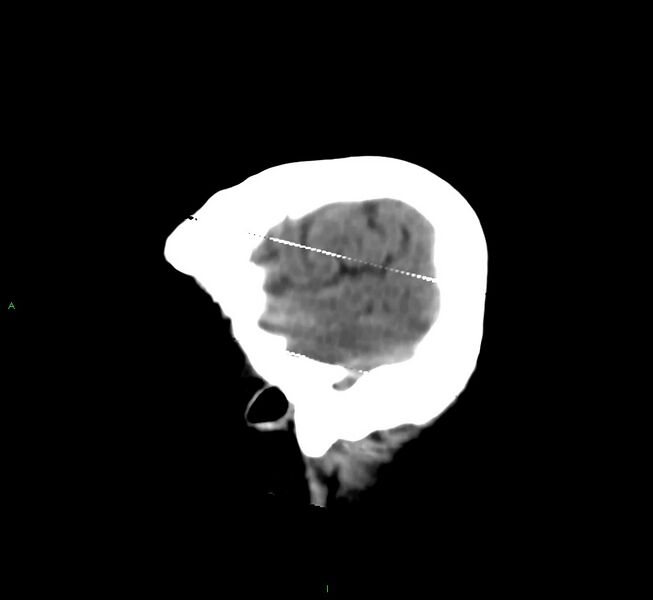 File:Cerebral amyloid angiopathy-associated lobar intracerebral hemorrhage (Radiopaedia 58377-65514 B 6).jpg