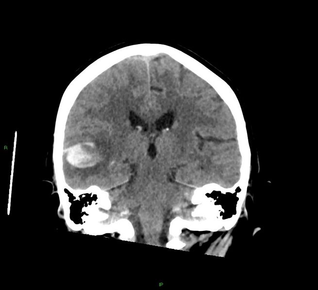 File:Cerebral amyloid angiopathy-associated lobar intracerebral hemorrhage (Radiopaedia 58378-65516 Coronal non-contrast 28).jpg