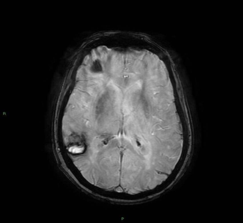 Cerebral amyloid angiopathy-associated lobar intracerebral hemorrhage (Radiopaedia 58378-65517 Axial SWI 40).jpg