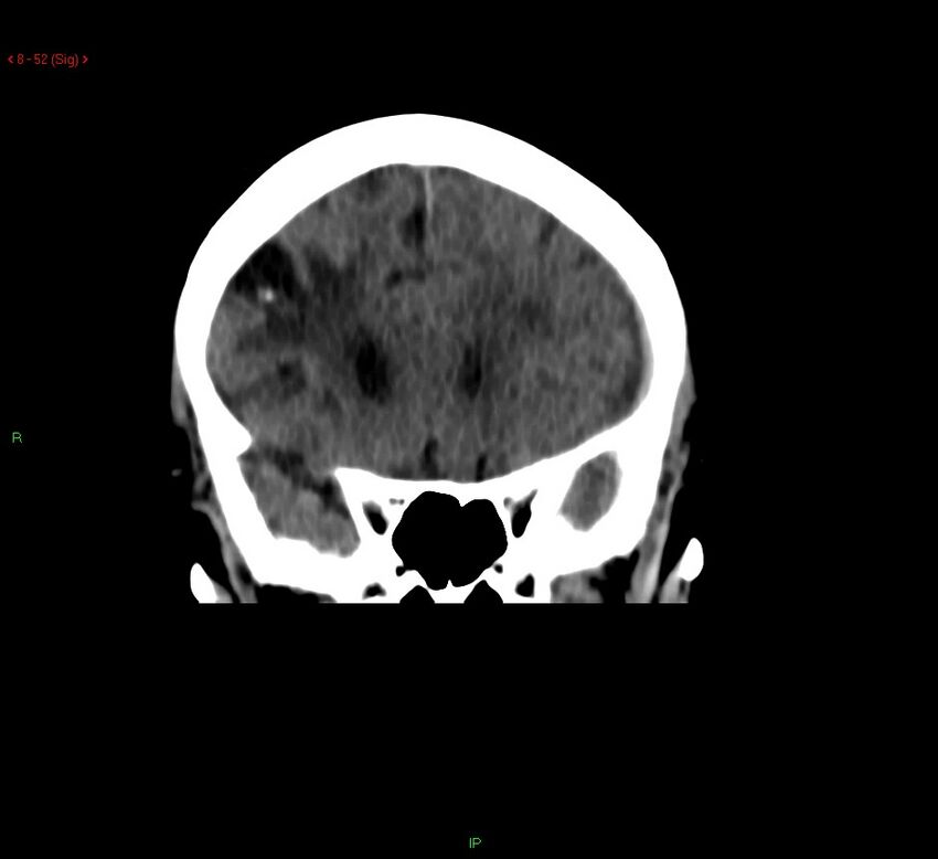 Cerebral amyloid angiopathy-associated lobar intracerebral hemorrhage (Radiopaedia 58378-65518 Coronal non-contrast 52).jpg