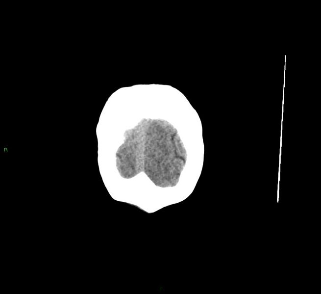File:Cerebral amyloid angiopathy-associated lobar intracerebral hemorrhage (Radiopaedia 58529-65681 Coronal non-contrast 7).jpg