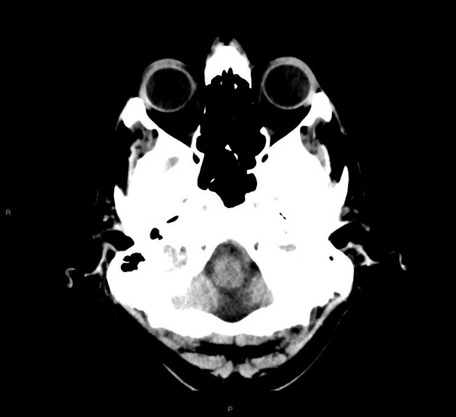 File:Cerebral amyloid angiopathy-associated lobar intracerebral hemorrhage (Radiopaedia 58529-65687 Axial non-contrast 44).jpg