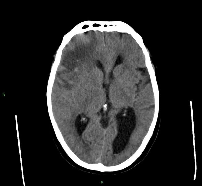 File:Cerebral amyloid angiopathy-associated lobar intracerebral hemorrhage (Radiopaedia 58560-65723 Axial non-contrast 29).jpg