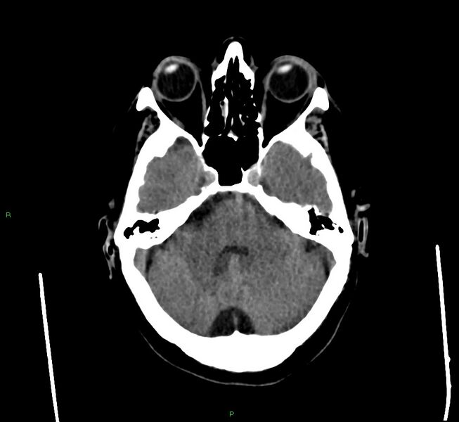 File:Cerebral amyloid angiopathy-associated lobar intracerebral hemorrhage (Radiopaedia 58560-65723 Axial non-contrast 39).jpg