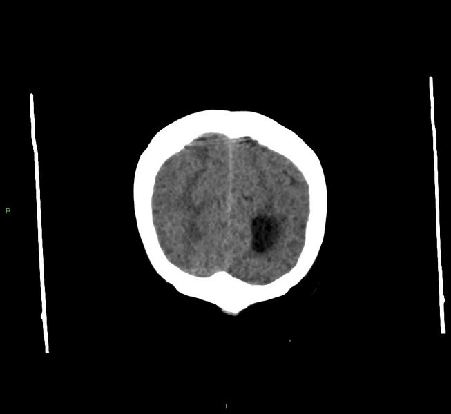 File:Cerebral amyloid angiopathy-associated lobar intracerebral hemorrhage (Radiopaedia 58560-65723 Coronal non-contrast 11).jpg