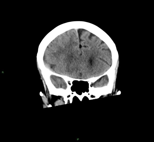 File:Cerebral amyloid angiopathy-associated lobar intracerebral hemorrhage (Radiopaedia 58563-65727 Coronal non-contrast 46).jpg