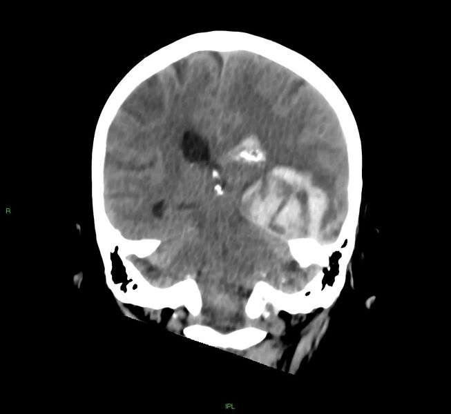 File:Cerebral amyloid angiopathy-associated lobar intracerebral hemorrhage (Radiopaedia 58754-65975 Coronal non-contrast 27).jpg