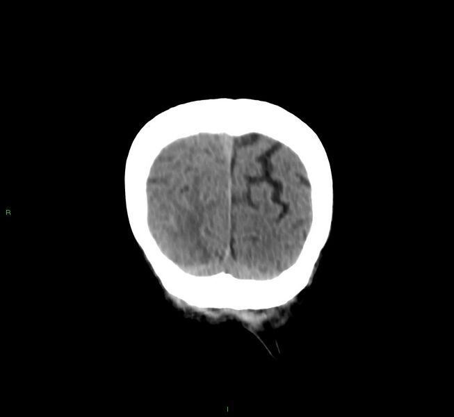 File:Cerebral amyloid angiopathy-associated lobar intracerebral hemorrhage (Radiopaedia 58758-65980 Coronal non-contrast 10).jpg